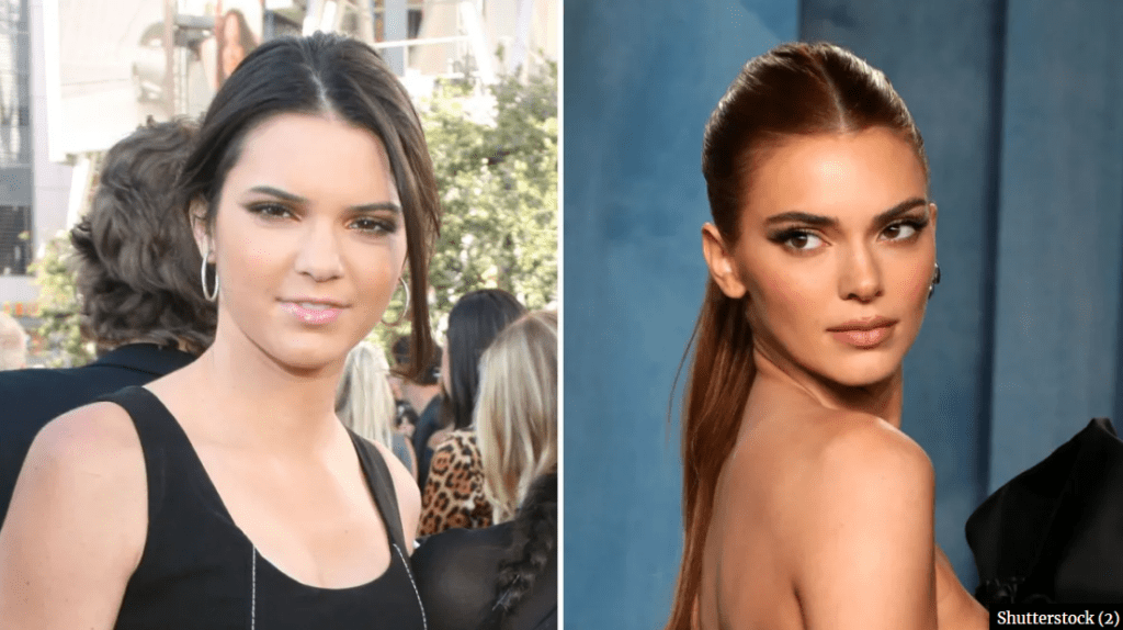 Kendall Jenner's Plastic Surgery Rumors 2