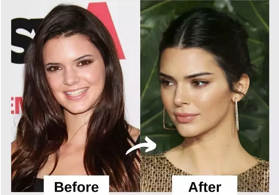 Kendall Jenner's Plastic Surgery Rumors